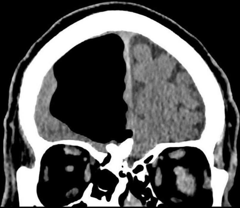 After CT and MRI scans, the medical team of an 84-year-old patient made an alarming discovery: Where much of the man's right frontal lobe of his brain should have been, there was simply a large blank space. (BMJ Case Reports)