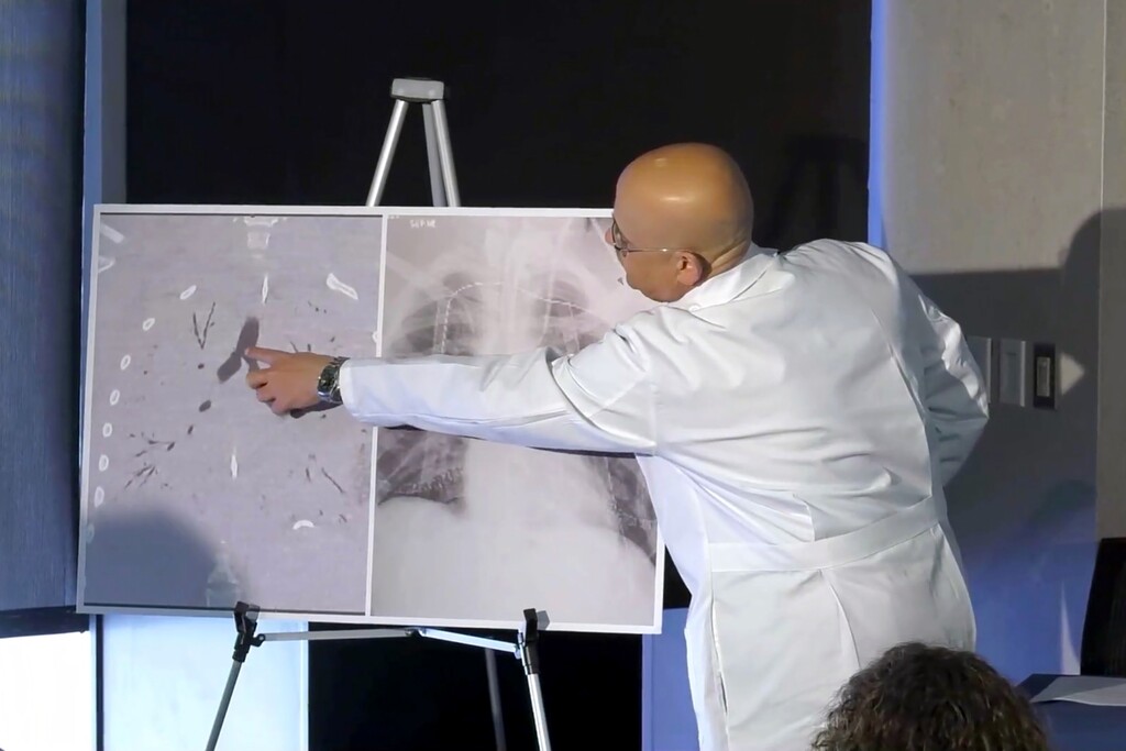 (Henry Ford Health system via The New York Times) Dr. Hassan Nemeh, who performed the first double-lung transplant of a patient injured by vaping, points to a scan of the patient’s empty-looking lungs before the surgery during a news conference at the Henry Ford Hospital in Detroit, on Nov. 12, 2019. The surgery on the 17-year-old was the first transplant reported in the recent nationwide outbreak of vaping-related lung injuries.