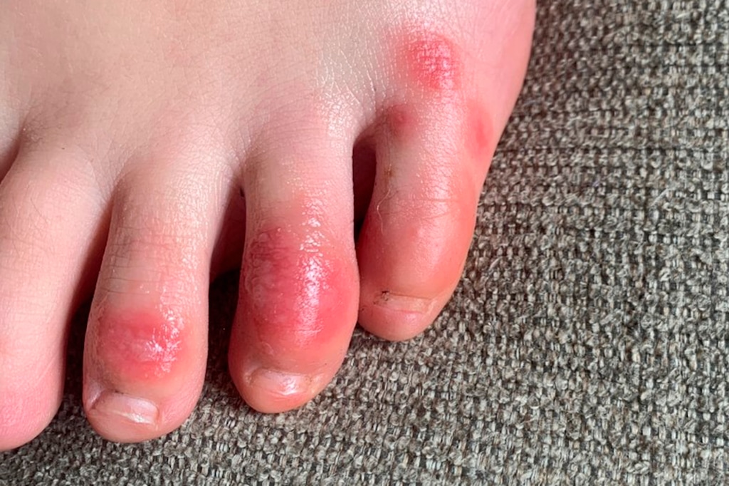 (Courtesy of Dr. Amy Paller | Northwestern University via AP) This April 3, 2020 photo provided by Northwestern University shows discoloration on a teenage patient's toes at the onset of the condition informally called "COVID toes." The red, sore and sometimes itchy swellings on toes look like chilblains, something doctors normally see on the feet and hands of people who’ve spent a long time outdoors in the cold.