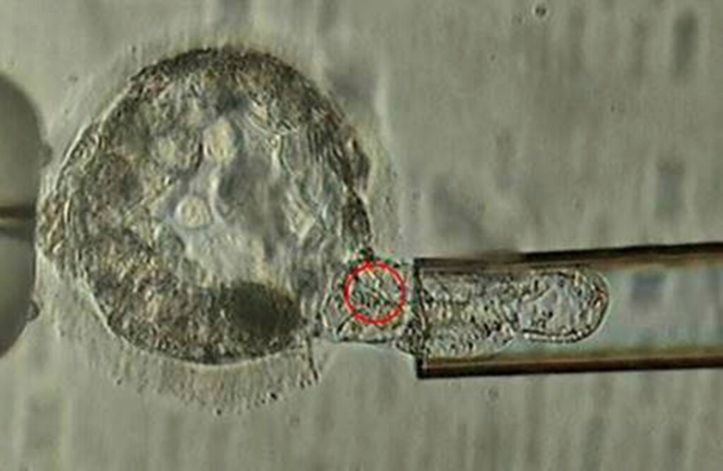 This undated microscope image provided by the American Society for Reproductive Medicine in January 2018 shows a trophectoderm biopsy, in which cells from the outer layer of an embryo that develop into the placenta and amniotic membranes are removed and can be used for genetic testing. (ASRM via AP)