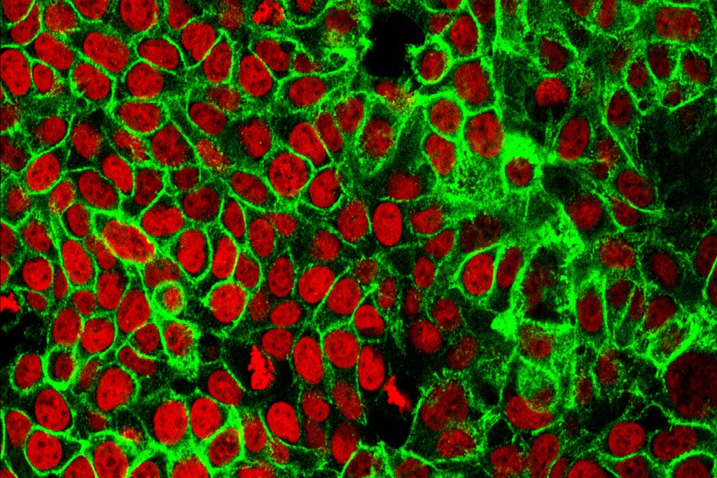 (NCI Center for Cancer Research | The Associated Press) This microscope image made available by the National Cancer Institute Center for Cancer Research in 2015 shows human colon cancer cells with the nuclei stained red. On Friday, May 29, 2020, doctors are reporting success with newer drugs that control certain types of cancer better, reduce the risk it will come back and make treatment simpler and easier to bear.