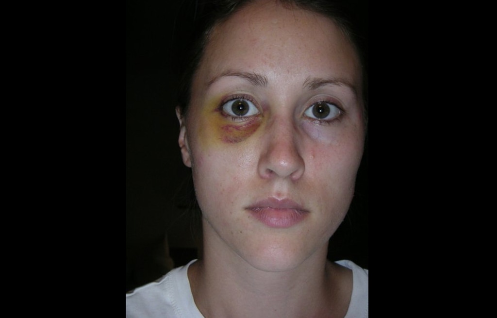 (Photo courtesy of Colbie Holderness) Rob Porter's ex-wife Colbie Holderness is pictured in a photo from 2005, when she says Porter gave her a black eye on an Italy trip.