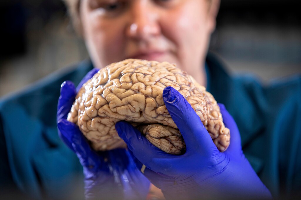 (Mark Cornelison | University of Kentucky via AP file) University of Kentucky, Donna Wilcock, of the Sanders-Brown Center on Aging, holds a brain in her lab in Lexington, Ky. She says that contrary to popular perception, "there are a lot of changes that happen in the aging brain that lead to dementia in addition to plaques and tangles."