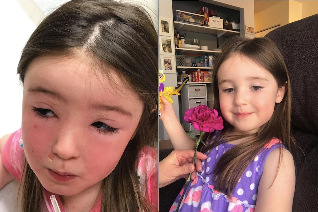 (Photo courtesy of Monica Stapley) Evie Stapley, 4, was taken to the emergency room after her eyelids swelled almost shut and she developed a blistering rash. Initially diagnosed as a virus, the inflammation was due to contact with the caustic sap of myrtle spurge, an invasive plant she discovered on a preschool nature walk in Salt Lake City on Tuesday, March 30, 2021. Here she is shown while the reaction was underway, at left, and before she had contact with the plant, at right.