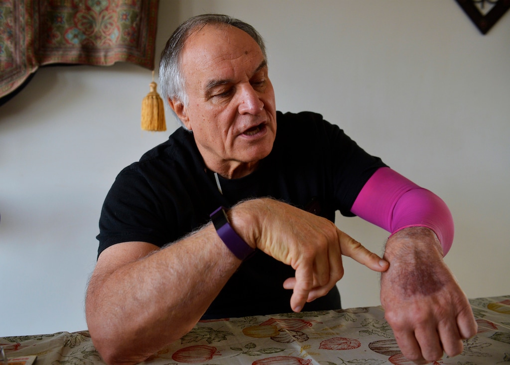 (Rion Sanders | The Great Falls Tribune | The Associated Press) Chuck Merja, a farmer and founder of the Sun River Robotics team, shows off his burn scars in this Nov. 14, 2018, photo. Merja, former president of the Montana Grain Growers Association, was doused in superheated radiator fluid in May after a radiator hose ruptured in Sun River, Mont.