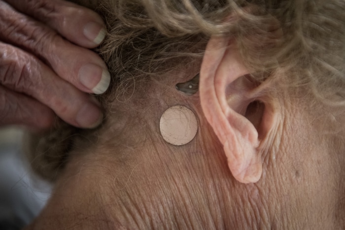 (Loren Elliott  |  For The Washington Post)  Dorothy O'Connell displays a patch used to counteract her vertigo. Dilley said O'Connell has been left with damaged vision, hearing and balance.