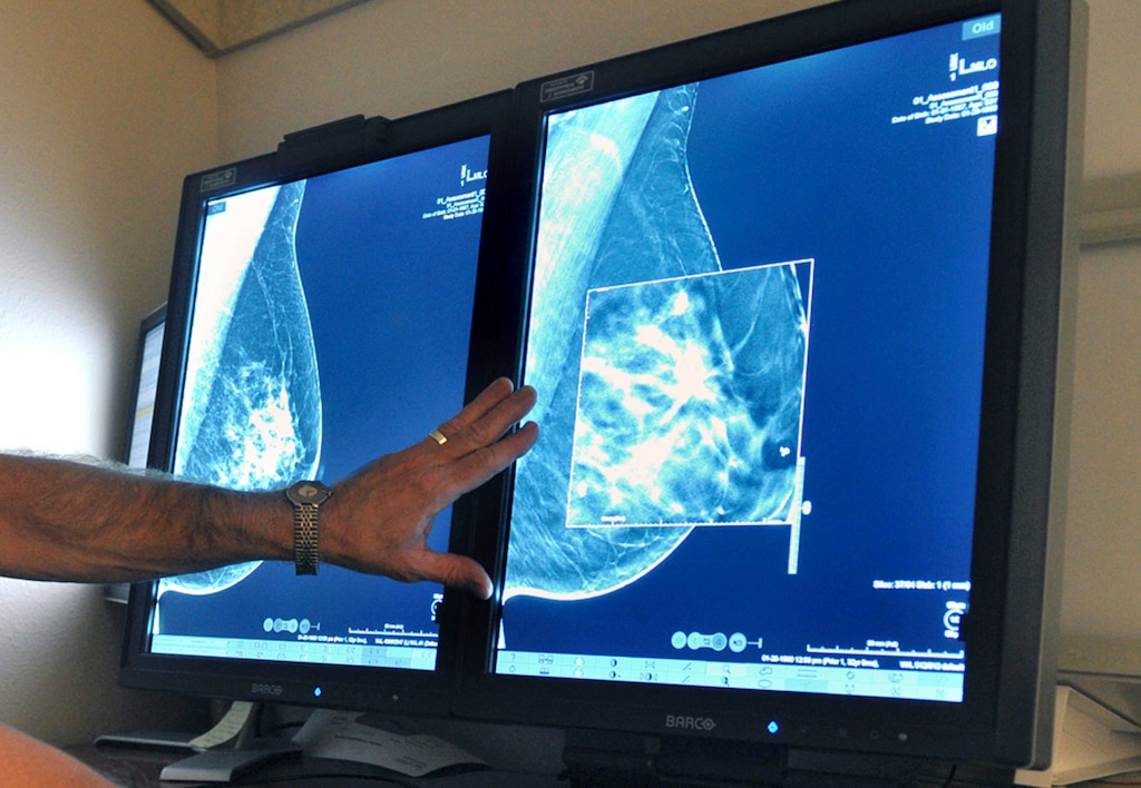(Torin Halsey | Times Record News | The Associated Press) This July 31, 2012, photo shows a mammogram, a test to detect cancer. A new study suggests that adding MRIs to mammograms to screen women with very dense breasts may find more cancers but also gives a lot of false alarms.