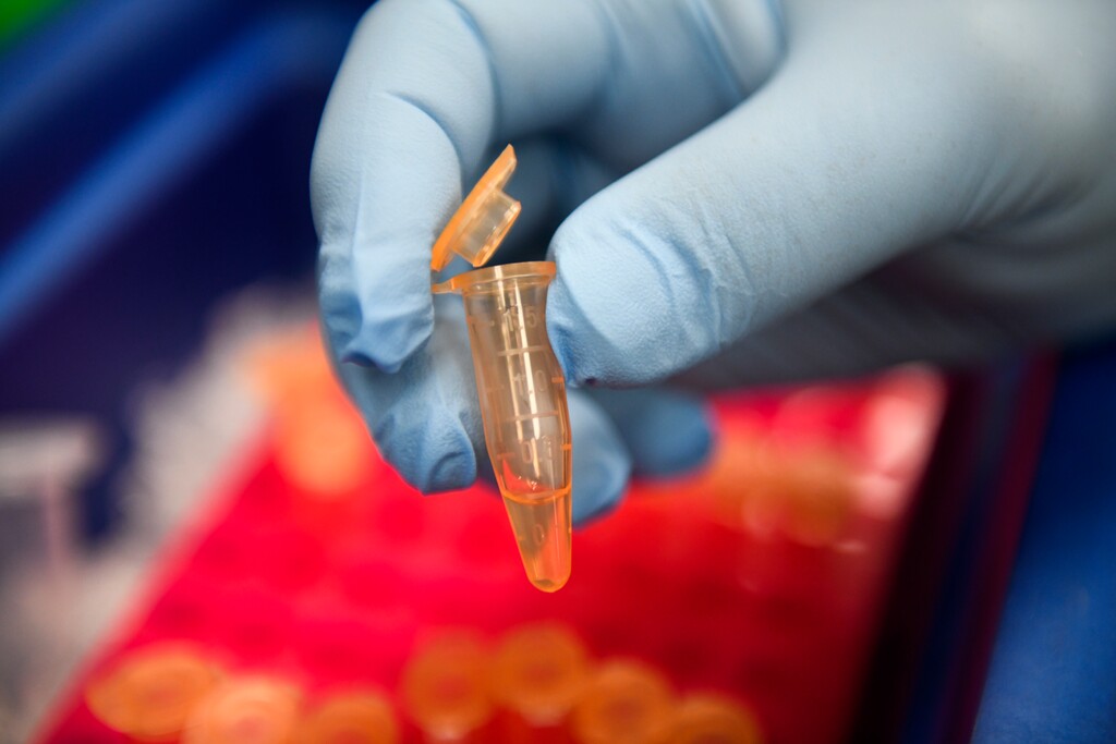 (Denis Poroy | The Associated Press) Michael Catania, vice president of product development, holds up a patient sample at Banyan Biomarkers Tuesday, Feb. 13, 2018, in San Diego. The company is developing a blood test to help doctors diagnose traumatic brain injuries.