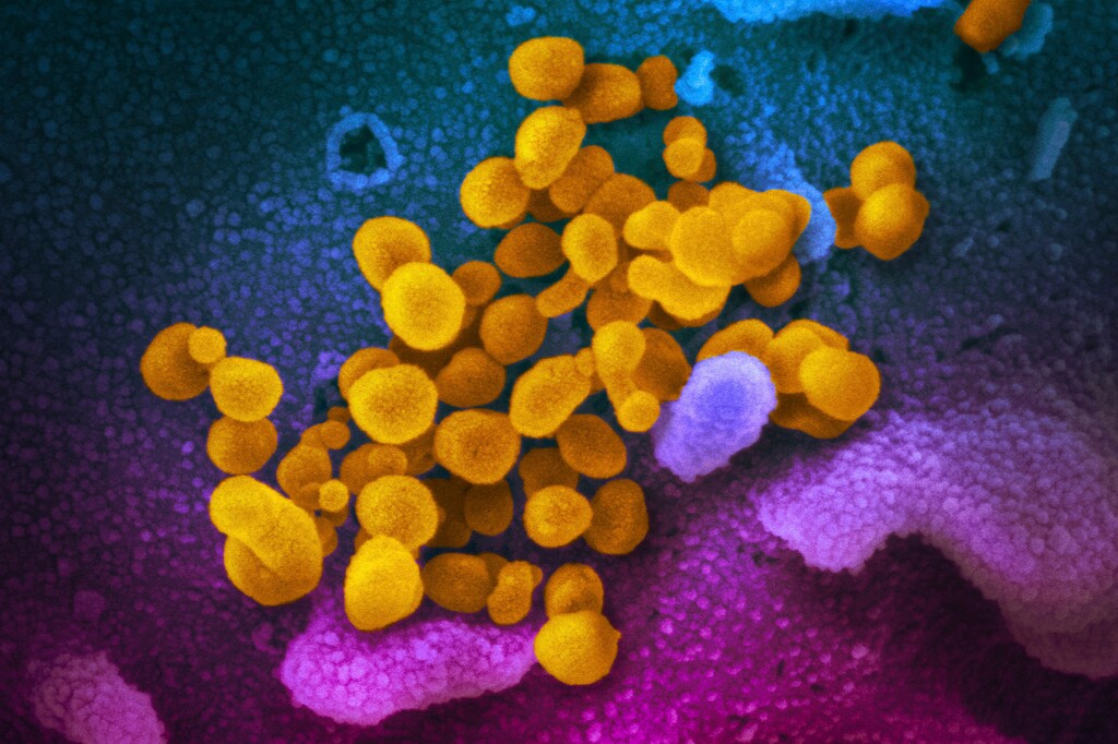 (Image courtesy of NIAID-RML) This undated electron microscope image made available by the U.S. National Institutes of Health in February 2020 shows the Novel Coronavirus SARS-CoV-2, yellow, emerging from the surface of cells, blue/pink, cultured in the lab. The sample was isolated from a patient in the U.S.