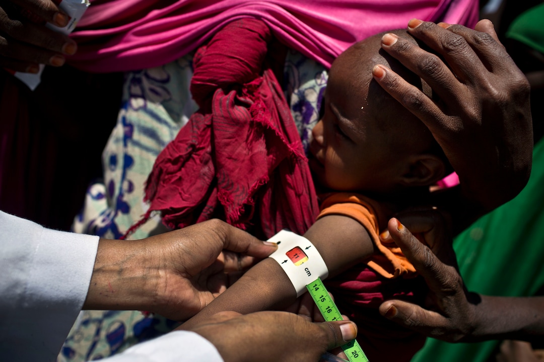 (© UNICEF/UN057372/Holt; Courtesy LDS Church) A medical practitioner uses a Mid Upper-Arm Circumference (MUAC) measuring tape on a child indicating Severe Acute Malnutrition (SAM) at a mobile clinic at a temporary settlement for families who have been forced to move because of drought near the town of Ainabo, Somalia, Thursday 9 March 2017.