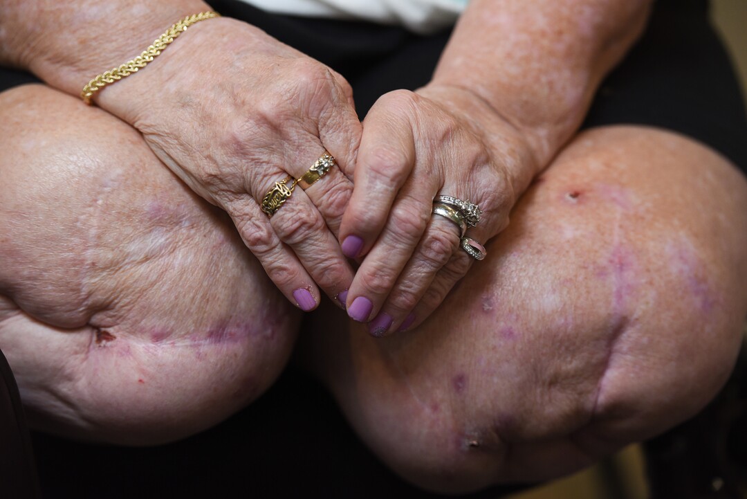 (Francisco Kjolseth  |  The Salt Lake Tribune)  Bonnie Foerster, 74, of South Salt Lake, finally gets her wish of marrying her partner of 50 years, Beverly Grossaint, even though Grossaint died on May 27, 2018. Foerster wears her partner's rings as well as her own. Foerster, who is legally blind and a double amputee, shed tears of joy on Tuesday, Aug. 21, 2018, exclaiming, "I can finally start healing," after a judge provided the legal recognition and allowed her to be legally married.