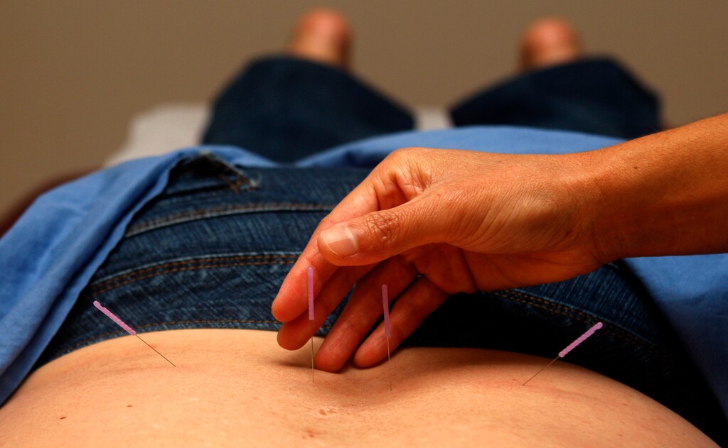 (Lenny Ignelzi | The Associated Press) This Oct. 28, 2009 photo shows Christine Kinsella, a licensed acupuncturist and Chinese Herbalist, treating patient Cynde Durnford-Branecki during an acupuncture treatment in San Diego. Durnford-Branecki prefers acupuncture to pain pills, and her insurance covers treatments.