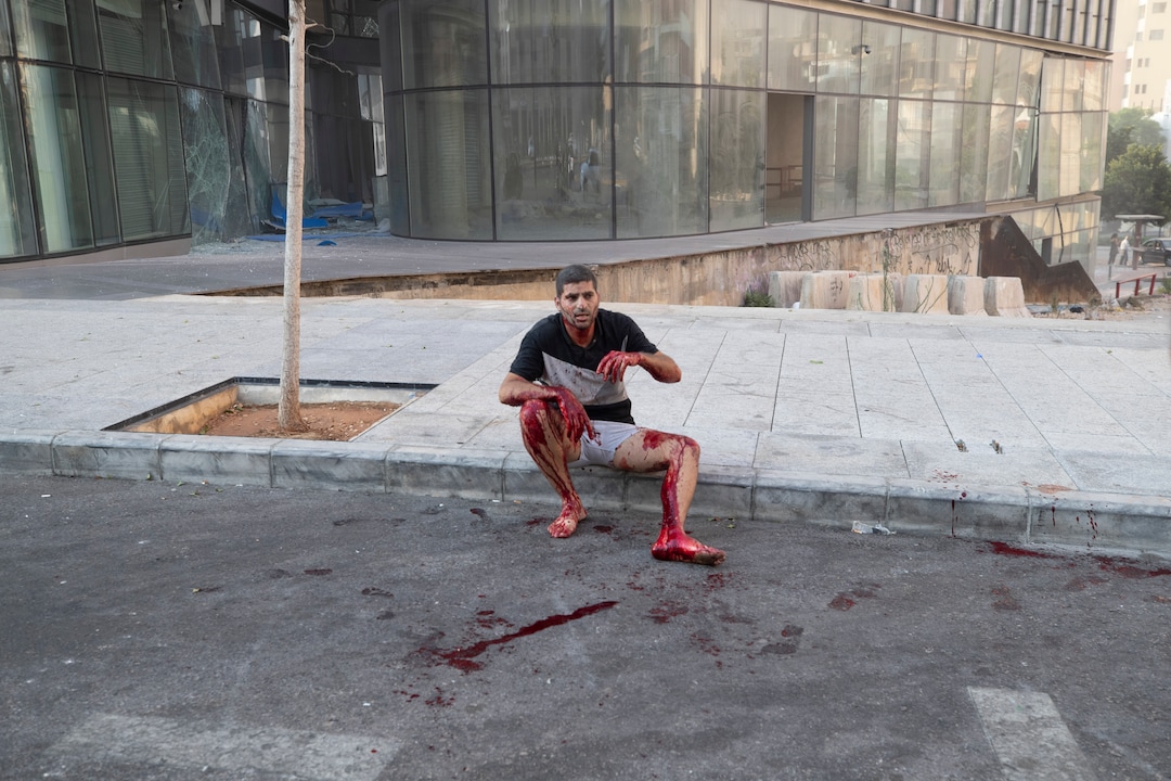 A wounded man sits on a sidewalk after a massive explosion in in Beirut, Lebanon, Tuesday, Aug. 4, 2020. Massive explosions rocked downtown Beirut on Tuesday, flattening much of the port, damaging buildings and blowing out windows and doors as a giant mushroom cloud rose above the capital. Witnesses saw many people injured by flying glass and debris. (AP Photo/Hassan Ammar)