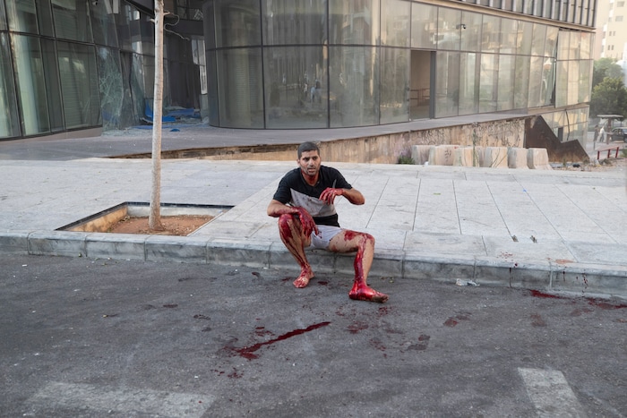 A wounded man sits on a sidewalk after a massive explosion in in Beirut, Lebanon, Tuesday, Aug. 4, 2020. Massive explosions rocked downtown Beirut on Tuesday, flattening much of the port, damaging buildings and blowing out windows and doors as a giant mushroom cloud rose above the capital. Witnesses saw many people injured by flying glass and debris. (AP Photo/Hassan Ammar)