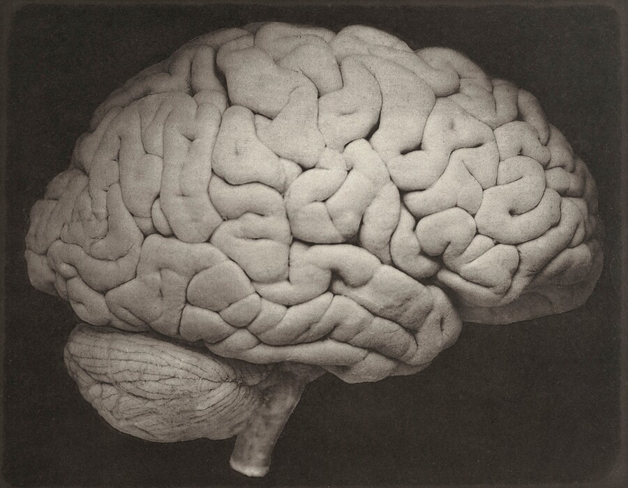 This 1885 photo shows a side view of a human brain. In relation to body size, our brains are huge, about six times larger than one would expect from other mammals. And this three-pound organ sucks up fully 20 percent of the body’s energy needs. (Oscar G. Mason/J.C. Dalton/Philadelphia, Lea Brothers & Co. via AP)