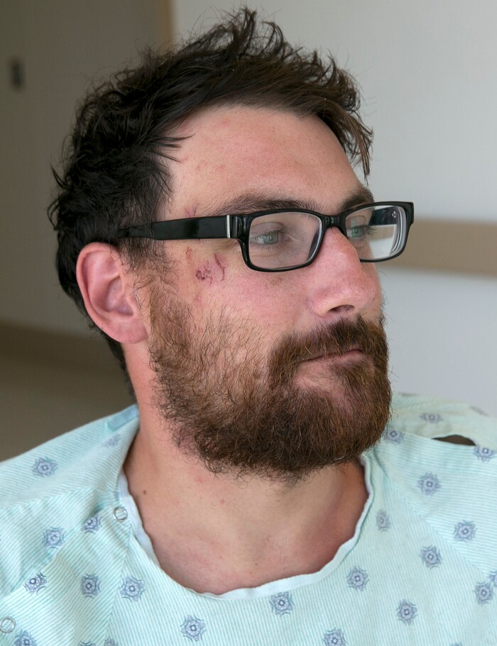 Mathias Steinhuber, of Innsbruck, Austria, who survived being struck by a lighting bolt, pauses while discussing the near-fatal event, Thursday, Aug. 24, 2017, in Sacramento, Calif. Steinhuber had been hiking the Pacific Crest Trail near Donner Summit Tuesday when he stopped to take a photo and was hit by the lighting. He was taken by helicopter to the the Tahoe Forest Hospital in Truckee, before being flown to the University of California, Davis Hospital Burn Center where he is listed in fair condition. He said he received the wound near his eye from falling on rocks after the lighting strike. (AP Photo/Rich Pedroncelli)