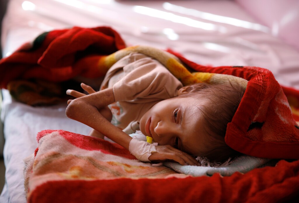 FILE - In this Jan. 24, 2016 file photo, a malnourished child lies in a bed waiting to receive treatment at a therapeutic feeding center in a hospital in Sanaa, Yemen. Save the Children, an international aid group said late Wednesday, Nov. 15, 2017, that an estimated 130 children or more die every day in war-torn Yemen from extreme hunger and disease.(AP Photo/Hani Mohammed, File)