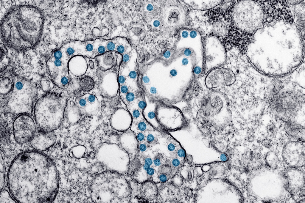 This 2020 electron microscope image made available by the U.S. Centers for Disease Control and Prevention shows the spherical particles of the new coronavirus, colorized blue, from the first U.S. case of COVID-19. Antibody blood tests for the coronavirus could play a key role in deciding whether millions of Americans can safely return to work and school. (Hannah A. Bullock, Azaibi Tamin/CDC via AP)