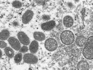 (CDC via The New York Times) An undated electron microscopy image provided by the Centers for Disease Control and Prevention of mature monkeypox virions, left, and immature virions, right, from a sample of human skin associated with the 2003 outbreak of monkeypox in the U.S.
